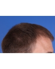 Before Hair Transplant&nbsp;Front
